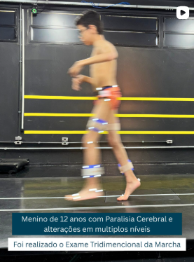 analise computadorizada da marcha